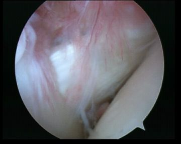 Arthroscopy Normal Subscapularis